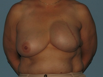 Received a left breast implant and a Breast Reconstruction after tissue expansion. after 963251