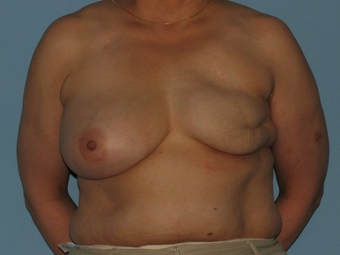 Received a left breast implant and a Breast Reconstruction after tissue expansion. before 963251