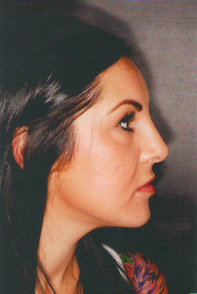 Septorhinoplasty after 923114