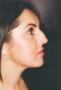 Septorhinoplasty before 923114