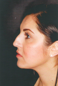 Septorhinoplasty 923114
