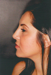 Septorhinoplasty 923114