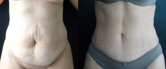 Belly Button Surgery after Tummy Tuck before 1192797