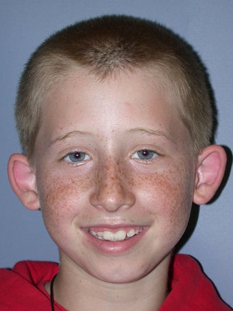 Otoplasty, Ear Surgery before 731964