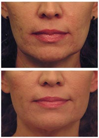 Laser Skin Tightening with acne scar improvement before 53749