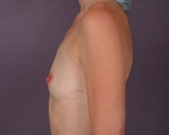 Breast Augmentation before 281430