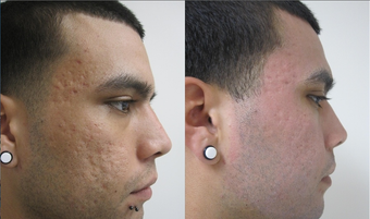 Fractional CO2 Resurfacing for Acne after 387836
