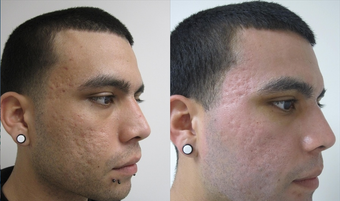 Fractional CO2 Resurfacing for Acne before 387836