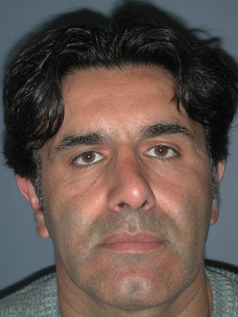 Otoplasty, Ear Surgery after 731966