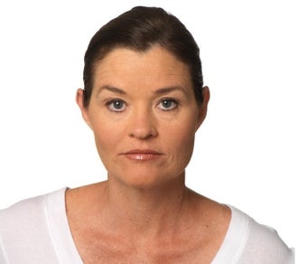Woman treated with Botox for frown lines after 1328545