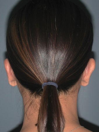 Otoplasty, Ear Surgery 731955