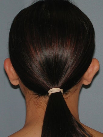 Otoplasty, Ear Surgery 731955