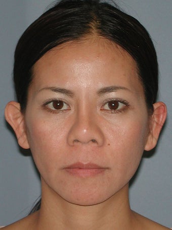 Otoplasty, Ear Surgery before 731955