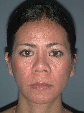 Otoplasty, Ear Surgery after 731955