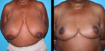 65 Year Old Woman - Breast Reduction before 1094104
