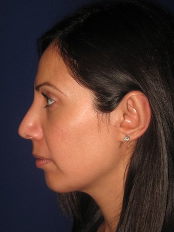 Chin Augmentation after 365339