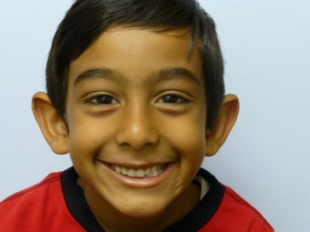 Childs otoplasty before 877671