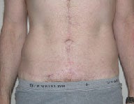 Dermolipectomy after 112076