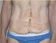 Dermolipectomy before 112076