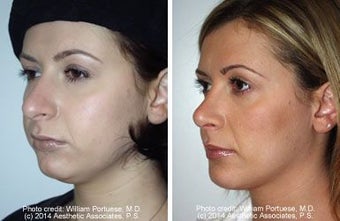 Neck Lift and Chin Implant before 91544