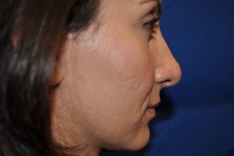 Female Patient Received Rhinoplasty to Remove Bump on Nasal Bridge after 892836