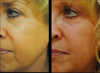 CO2 Laser before 981919
