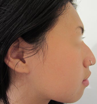 24 year-old female with nose hump treated with Restylane filler before 989340