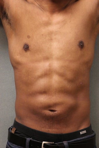 42 Year Male Treated to Increase Ab Definition after 824829