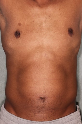 42 Year Male Treated to Increase Ab Definition before 824829