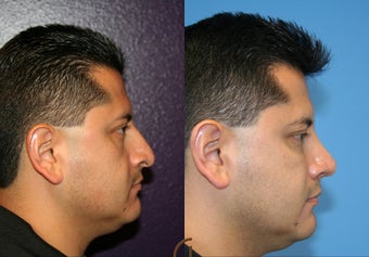 male rhinoplasty before 450431