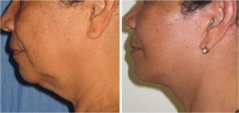 Neck Lift and Liposuction before 512859