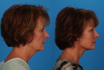 Facial Rejuvenation: 59-Year-Old Woman 1044697