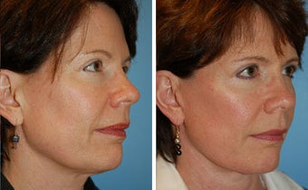 Facelift before 91476