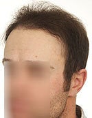 FUE – SFET Using Only Head Hair to Front and Crown Areas after 196026