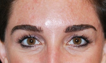 Botox 2 after 949272