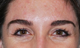 Botox 2 before 949272