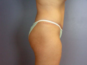 Tummy Tuck after 280144