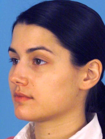 Septorhinoplasty 759269