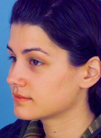 Septorhinoplasty 759269