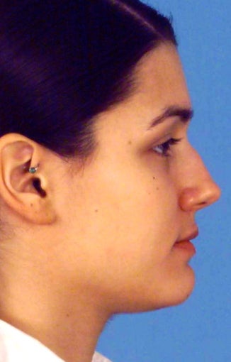 Septorhinoplasty before 759269