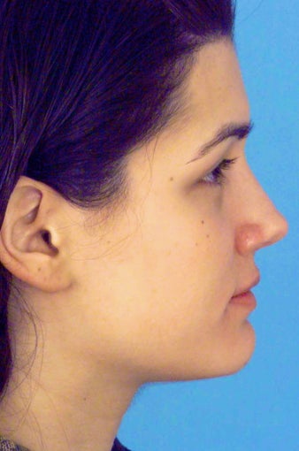 Septorhinoplasty after 759269