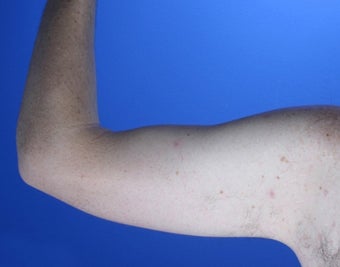 36 year old male weight loss patient with arm laxity 777570