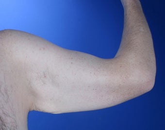 36 year old male weight loss patient with arm laxity before 777570