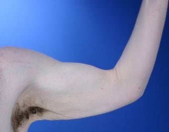 36 year old male weight loss patient with arm laxity 777570