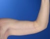 36 year old male weight loss patient with arm laxity after 777570