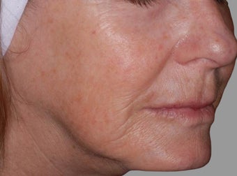 Exilis after 849403