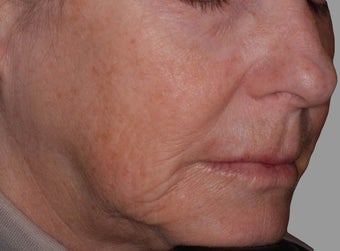 Exilis before 849403