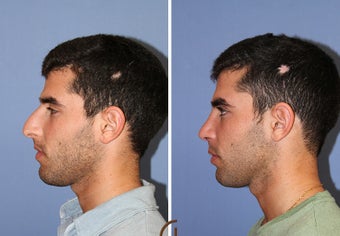 male rhinoplasty after 442586