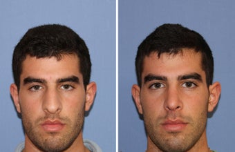 male rhinoplasty before 442586