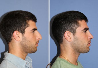 male rhinoplasty 442586